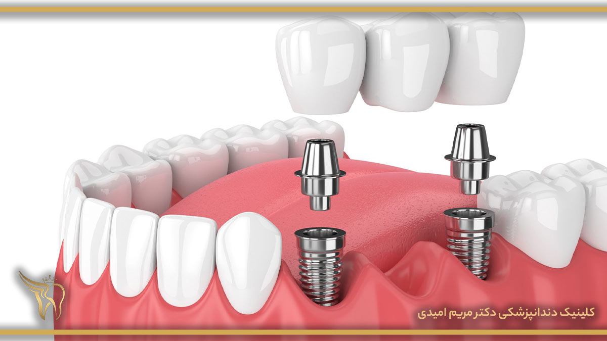 5 دلیل مناسب بودن تیتانیوم برای ایمپلنت دندان