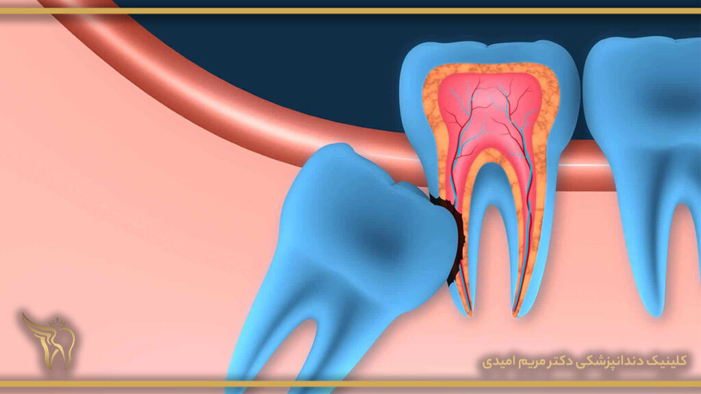 Wisdom tooth surgery