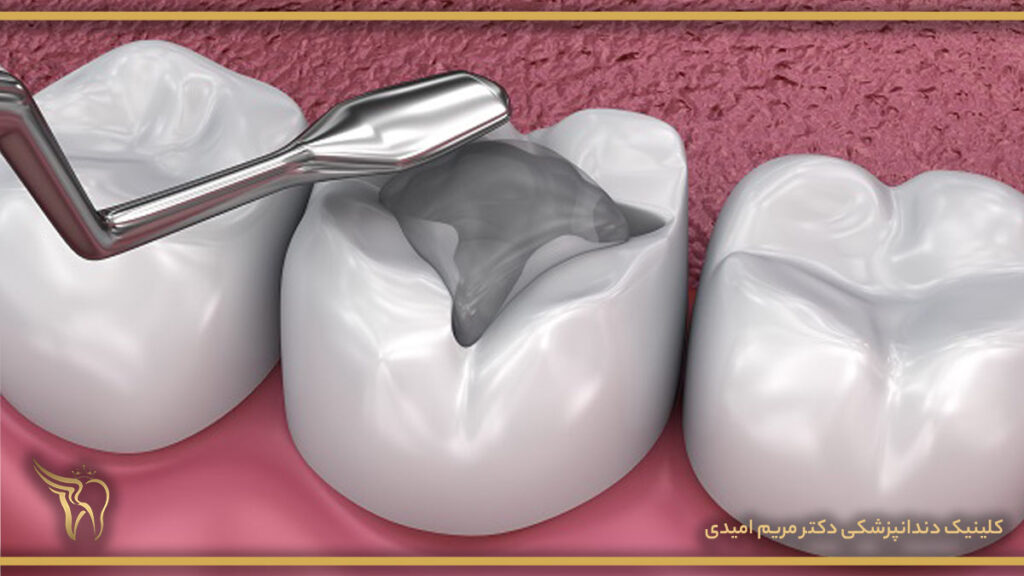 اگر دندان پر نشود چه اتفاقی رخ می‌دهد؟