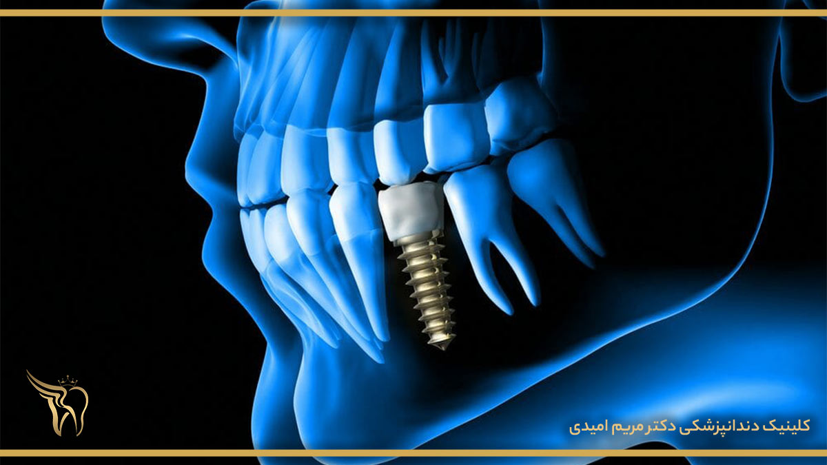 مراحل انجام عمل جراحی ایمپلنت دندان