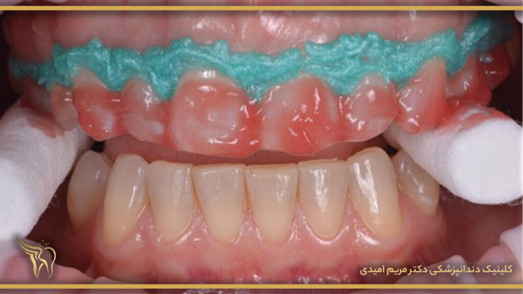 معایب بلیچینگ دندان