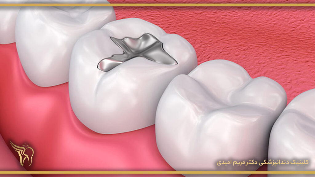 پر کردن دندان(dental fillings)  چیست؟