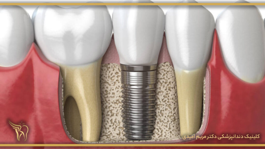 علت شل شدن ایمپلنت دندان