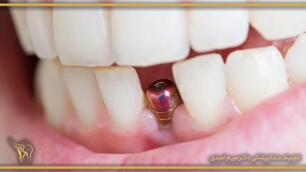 علت لق شدن ایمپلنت دندان