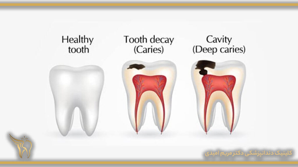 پوسیده شدن دندان